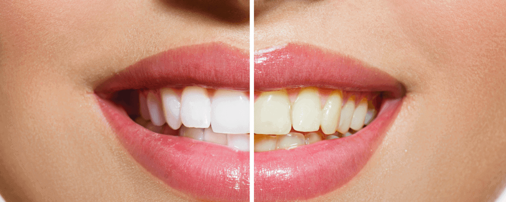 Teeth Whitening Dentist Dorset